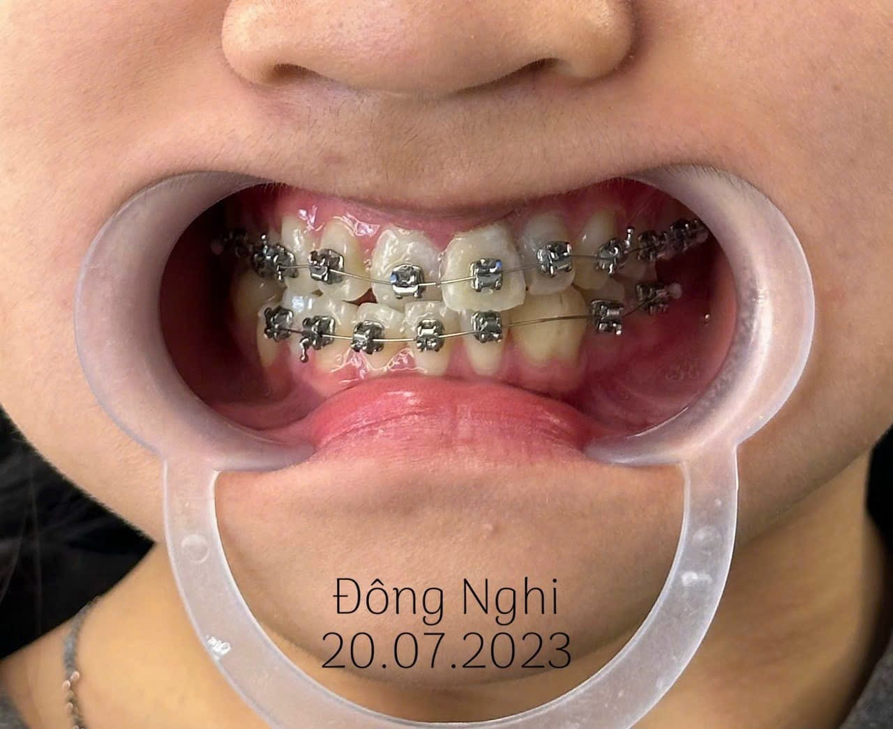 khách hàng chọn niềng răng tại nha khoa