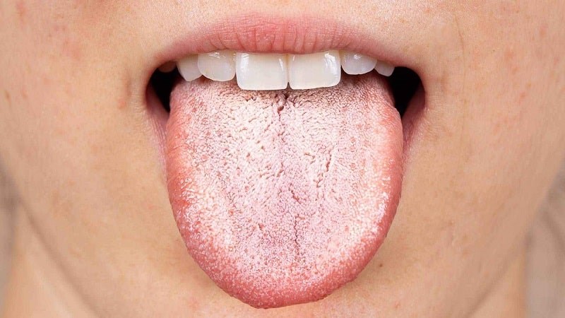 Tổng quan về bệnh nấm lưỡi
