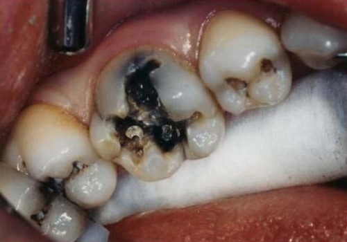 sâu răng và nguyên nhân sâu răng