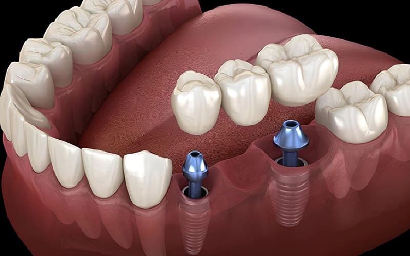 cầu răng sứ trên trụ implant