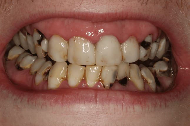 ảnh hưởng của việc kẽ răng bị đen