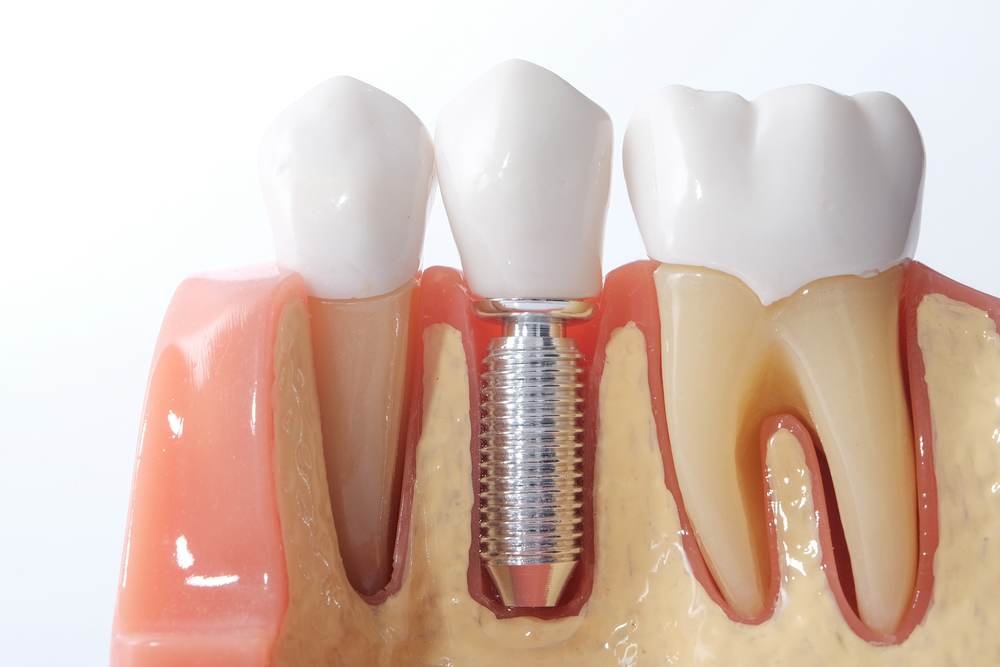 ghép implant cho răng