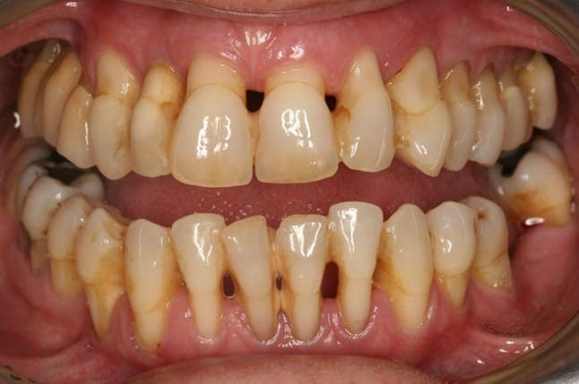 răng bị tụt lợi